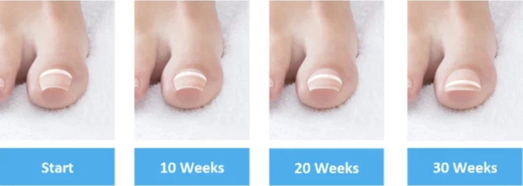 Onyfix® Ingrown Toenail Treatment in Atlanta GA