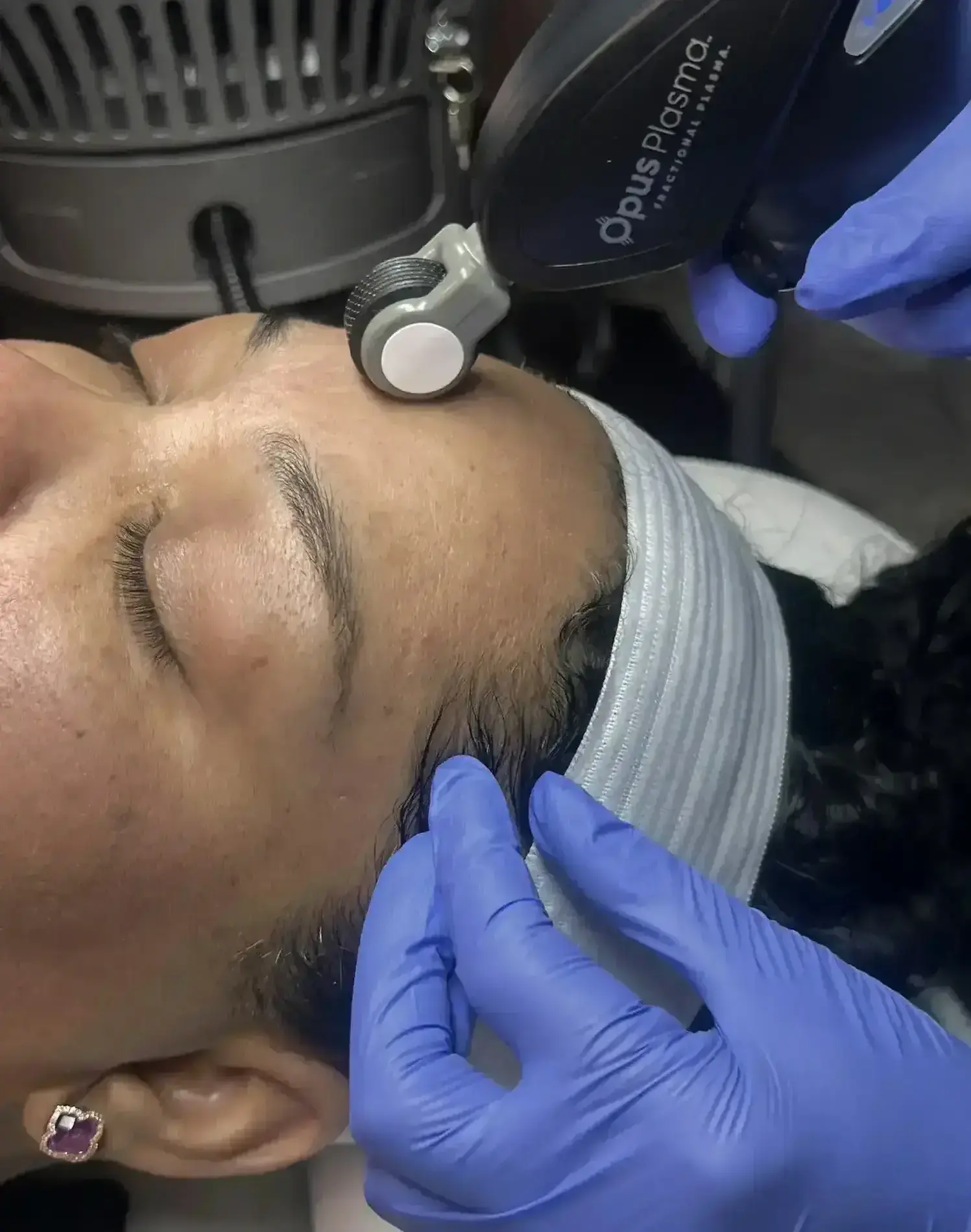 Skin Resurfacing Treatment in Atlanta GA